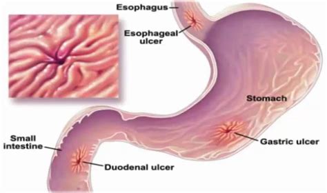 There's two way you can do that. Stomach Ulcer - Causes, Signs, Symptoms, Remedy, Treatment