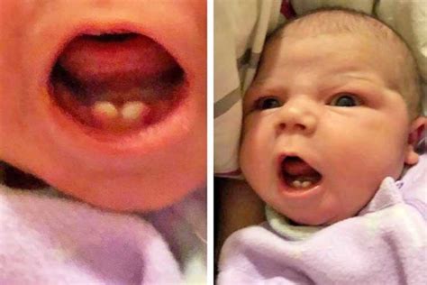 Babies Born With Teeth Core Plastic Surgery