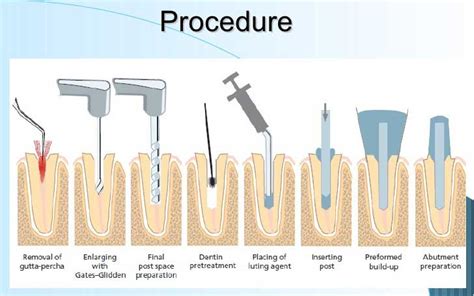 What Is A Post And Core For Teeth Restoration Central Valley Dentistry