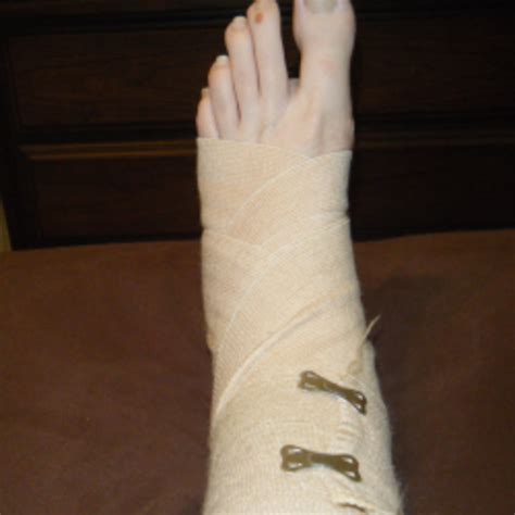 Broken Ankle Recovery Healdove