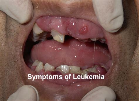Acute And Chronic Leukemia Symptoms Diagnosis And Treatment Health