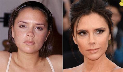 Victoria Beckham Before And After Plastic Surgery Victoria Beckham