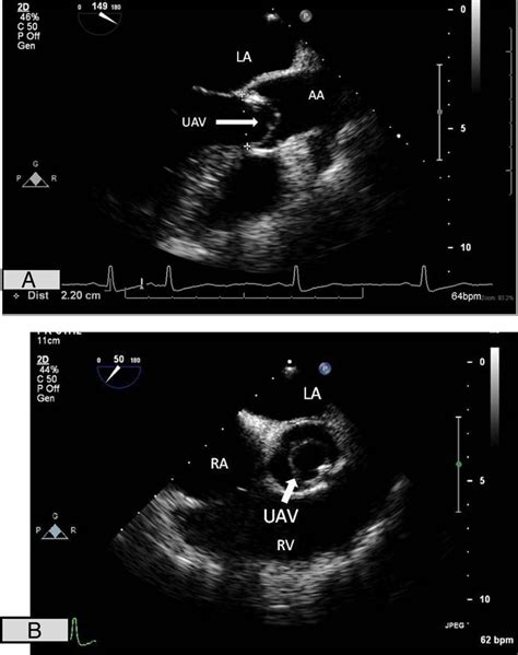 Symptomatic Unicuspid Aortic Valve Bmj Case Reports