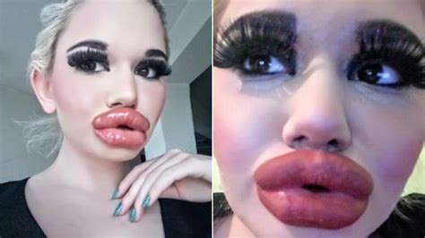 22 Year Old Bulgarian Woman Says She Didn T Count The Money To Get Biggest Lips In The World