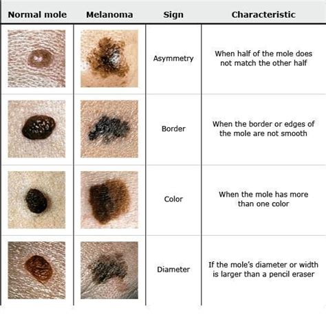 Pin On Skin Cancer Home Remedies Types Tips Risks