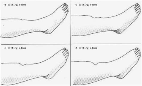 Pitting Edema Scale Grading And Assessment For Nurses