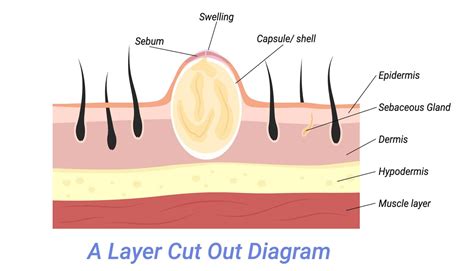 Milialar Small Bumps Under The Skin Explained
