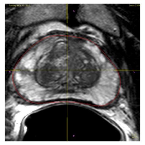 Pdf Multiparametric Mri In Biopsy Guidance For Prostate Cancer