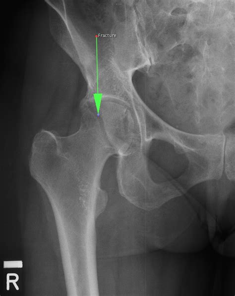 Posterior Acetabular Fracture Unidad Especializada En Ortopedia Y