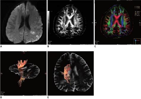 Diffusion Weighted Imaging And Diffusion Tensor Imaging Scans From