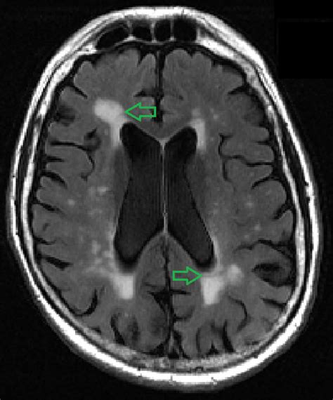 ‘white Matter Lesion Mapping Tool Identifies Early Signs Of Dementia