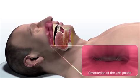 Inspire Sleep Apnea Treatment Simulation Youtube
