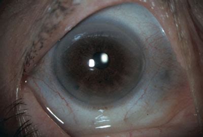 Some corneal ulcers may be too small to see without adequate magnification and illumination. The Whites of My Eyes Have Turned Blue! - American Academy ...