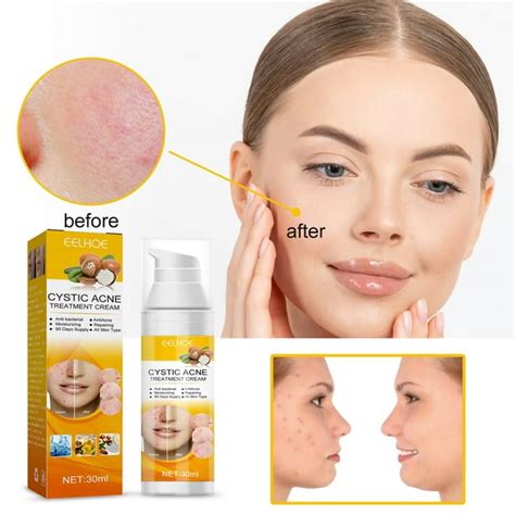 Acne Treat Cream Cystic Hormonal And Severe Acne Treat Cream For
