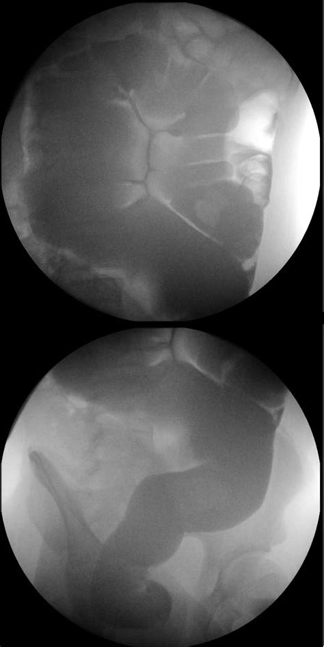 Cureus From The Cecum To The Sigmoid Twisted Colon In The Pediatric