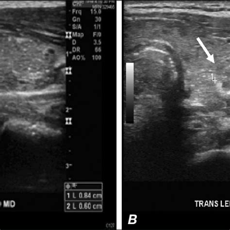 Doppler Ultrasonography Longitudinal Views Of The Right Lobe A And
