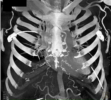 Coarctation Of The Aorta With Dilated Internal Mammary Arteries And