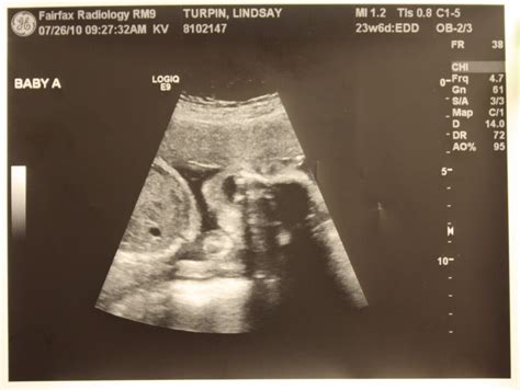 Adventures In Baby Making Week 24 Ultrasound