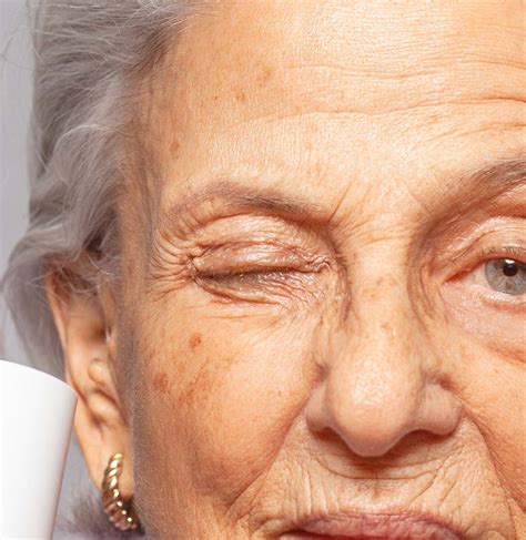 Weird Skin Conditions That Occurs As You Age
