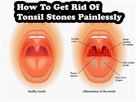 How To Get Rid Of White Spots On Tonsils Top Ways To Remove Tonsil