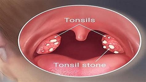 How To Remove Tonsil Stones Easily And Effectively Youtube