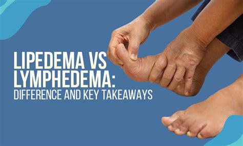 Lipedema Vs Lymphedema What Are The Important Differences