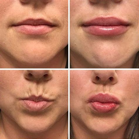 Dermal Fillers Add Life To Your Face The Proficient Way