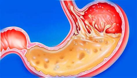 Желчь в желудке что это причины симптомы как диагностируется рефлюкс Ваша онлайн больница