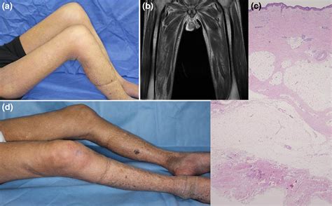 Eosinophilic Fasciitis With Severe Joint Contracture In A Patient With