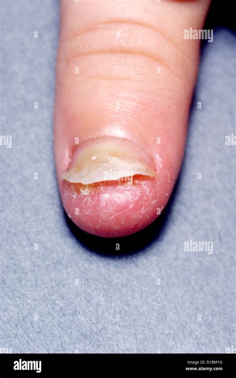 Fungal Infection Of Thumb Nail Stock Photo Alamy
