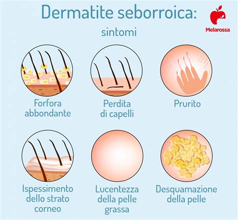 Dermatite Cos Tipologie Principali Cause Sintomi Cura E Trattamento The Best Porn Website