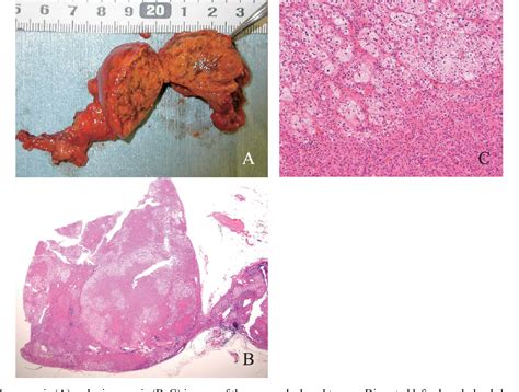 Figure 2 From A Case Of Cortisol Producing Adrenal Adenoma Without