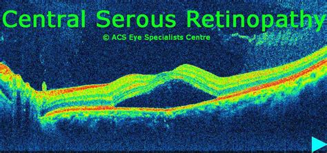 Schedule a consultation read more. ACS Eye Specialists - OCT - Optical Coherence Tomography ...