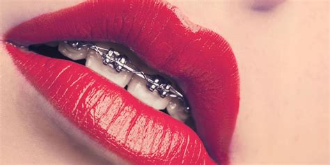 Why Adult Braces Are Becoming More Popular