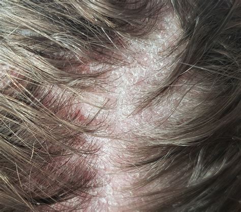 Are These Seborrheic Dermatitis Flakes Or True Dry Scalp Flakes R Haircarescience