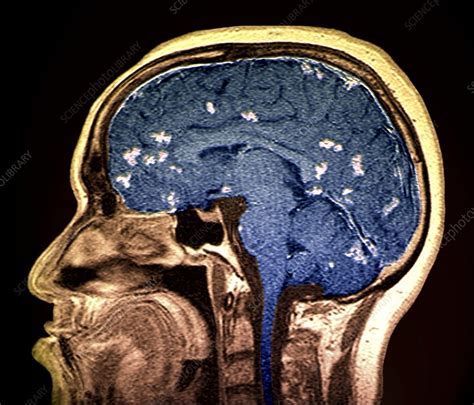 Diseased Brain Mri Scan Stock Image C0015248 Science Photo Library