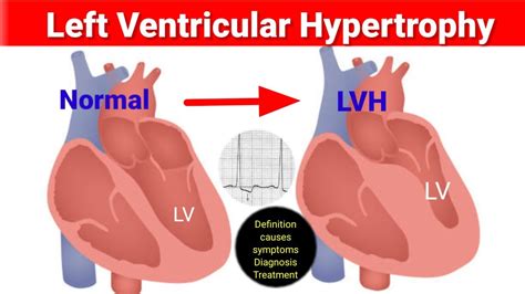 Lvh Left Ventricle Hypertrophy Causesdiagnosistreatment How To