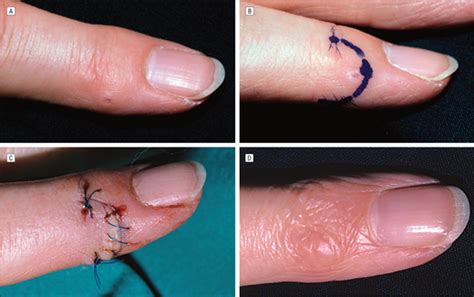 Skin Excision And Osteophyte Removal Is Not Required In The Surgical