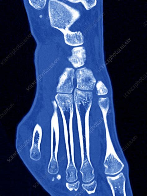 Foot Scan Stock Image C0171819 Science Photo Library