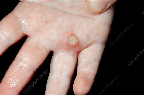 Wart On Hand Stock Image C0197575 Science Photo Library