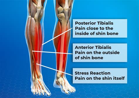 How To Get Rid Of Shin Splints Treat And Fully Recover
