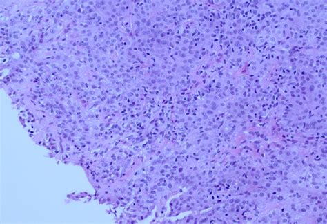 In the tubulopapillary growth pattern, it is common to identify psammoma bodies. Primary peritoneal epithelioid mesothelioma | Image ...