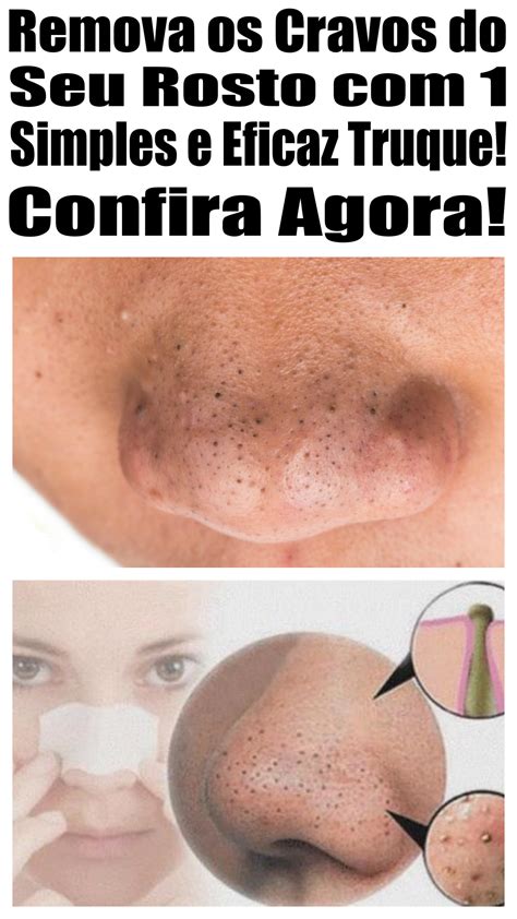 Veja O Jeito Mais FÁcil De Remover Cravos Do Nariz Dicas De Beleza Caseiras Tira Manchas Da