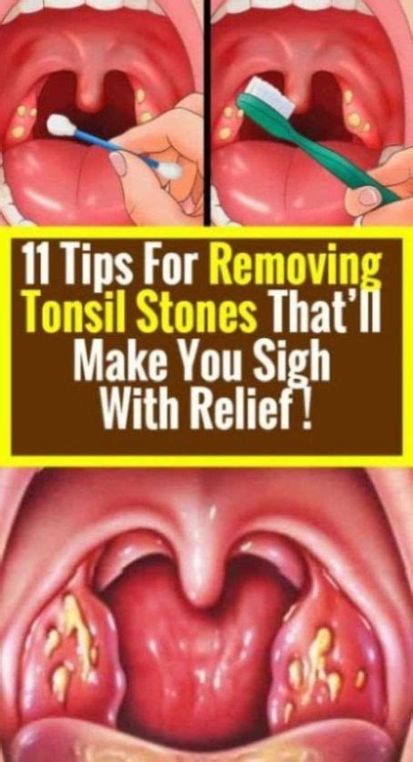 Tonsil Stones Causes Symptoms How To Remove Them My Xxx Hot Girl