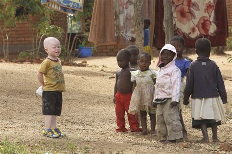 Albinism Inherited Melanin Deficiency Facing Ongoing Discrimination