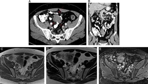 Postcontrast Computed Tomography Axial A And Coronal B Images Show