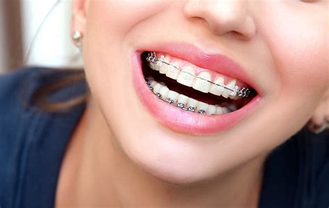 Fort Worth Orthodontist Offers Braces That Blend With Smiles Fort