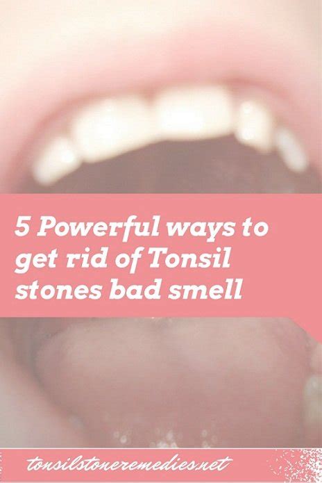 5 Powerful Ways To Get Rid Of Tonsil Stones Bad Smell