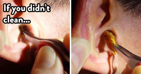 Causes And Brilliant Tips For Removing Earwax At Home Ear Wax Ear