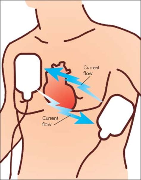 Biphasic waveform defibrillators current travels towards the +ve paddle & then reverses back. Defibrillation | Nurse Key